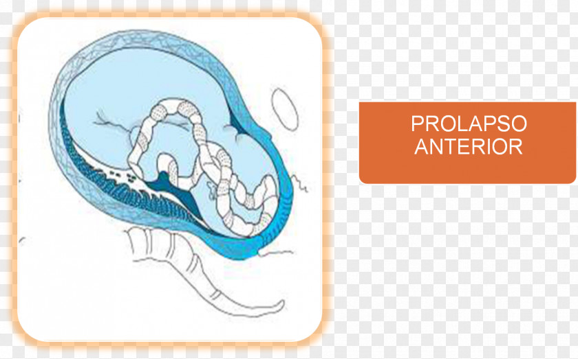 Pregnancy Umbilical Cord Prolapse Childbirth Mother PNG
