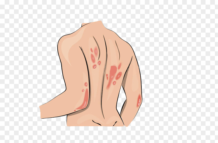 Back Skin Allergy Symptom Systemic Lupus Erythematosus Psoriasis PNG