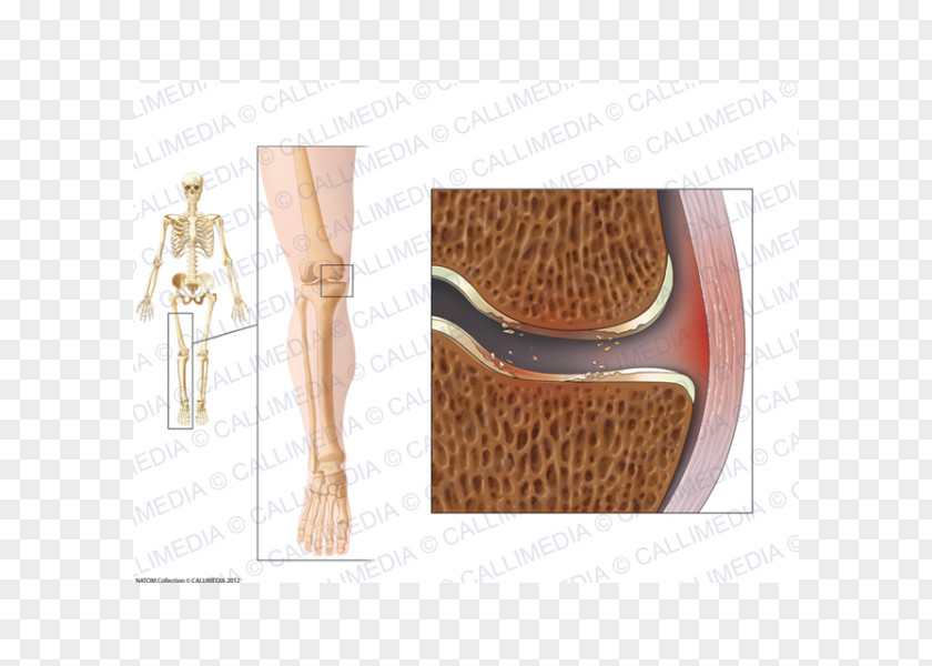 La Gonarthrose Knee Osteoarthritis Shoulder PNG