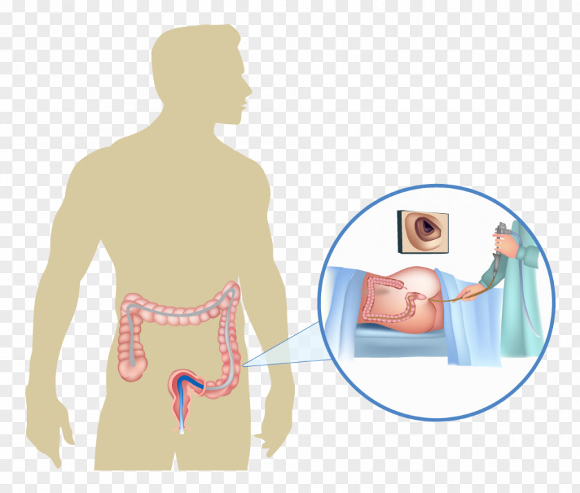 Cancer Patient Cartoon Colonoscopy Gastroenterology Endoscopy Colorectal Large Intestine PNG