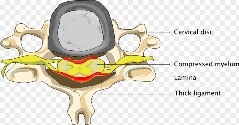 Cervical Spinal Stenosis Neck Cord PNG