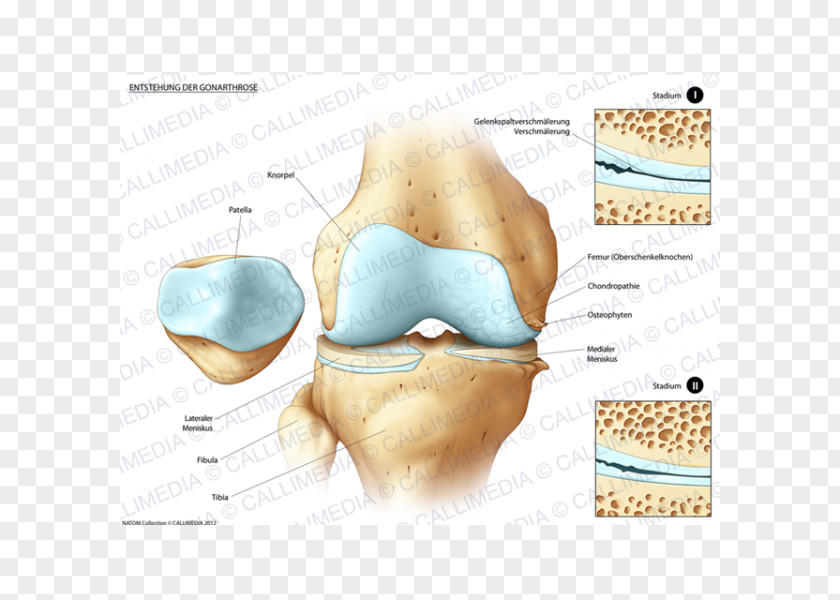 Artrosis De Rodilla Tibia Knee Pain Bone Fracture Joint PNG