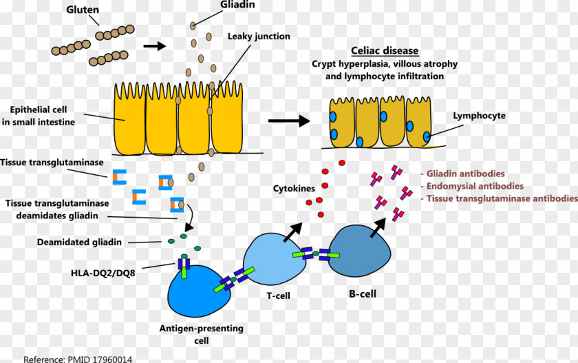 Celiac Disease Autoimmunity Autoimmune Autoantibody PNG