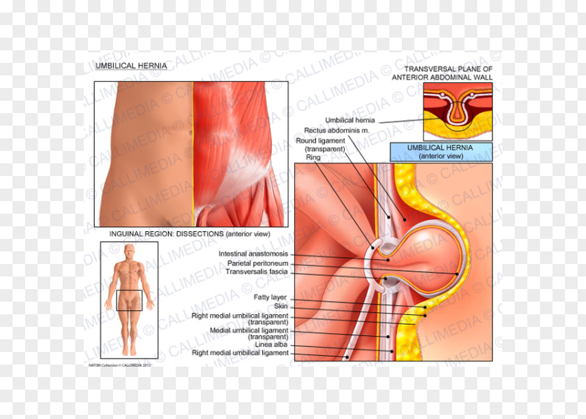Umbilical Hernia Repair Inguinal Abdominal PNG