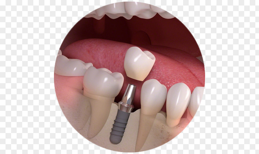 Implant Tooth Dental Dentistry Bridge PNG