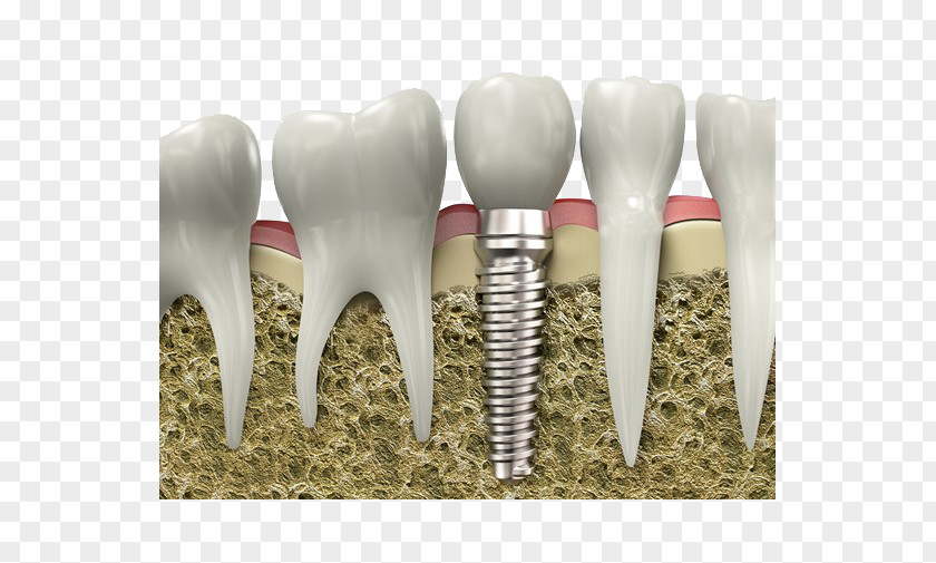 Growing Teeth Picture Material Dentistry Dental Implant Surgery Tooth PNG