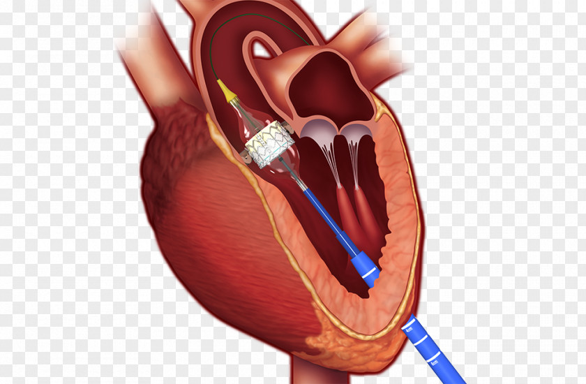 Heart Percutaneous Aortic Valve Replacement Valvular Stenosis Surgery PNG