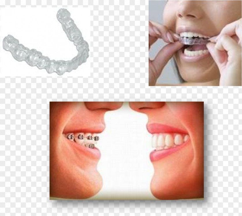 Villa Pavilion Tooth Dental Braces Orthodontics Crossbite Dentist PNG