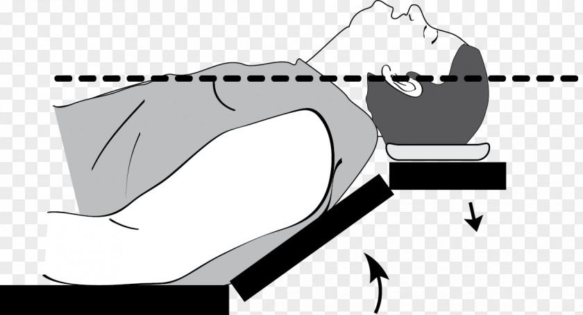 Ramp Tracheal Intubation Airway Management Patient Apnea PNG