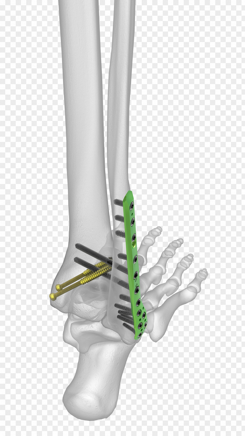 Fibula Human Leg Ankle Fracture Malleolus PNG leg fracture Malleolus, plating clipart PNG