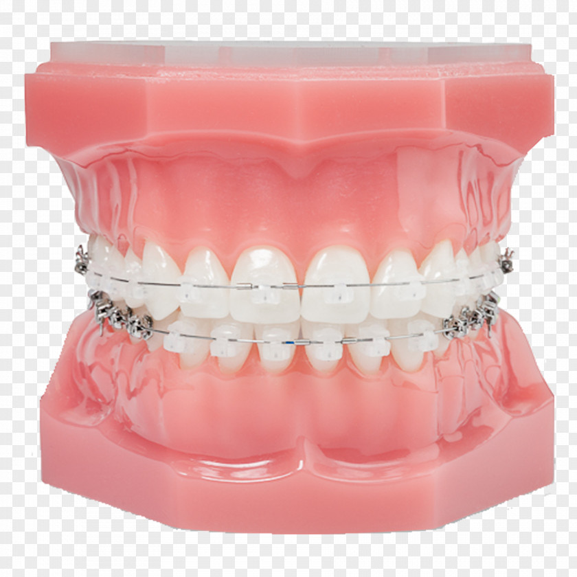 Damon System Orthodontics Dental Braces Clear Aligners Self-ligating Bracket PNG