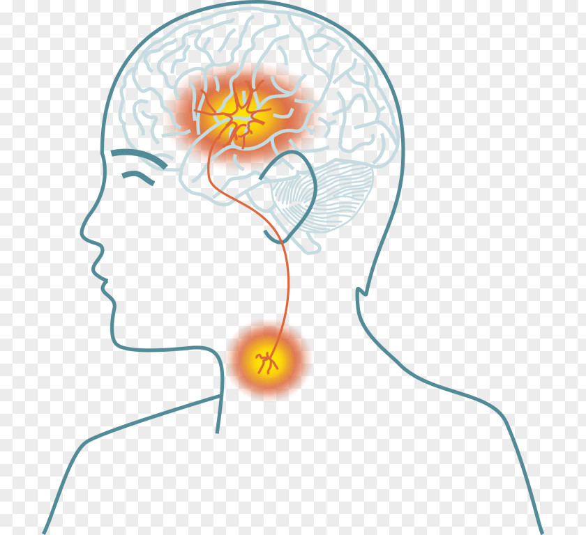 Brain Dysphagia Transient Ischemic Attack Stroke Symptom PNG