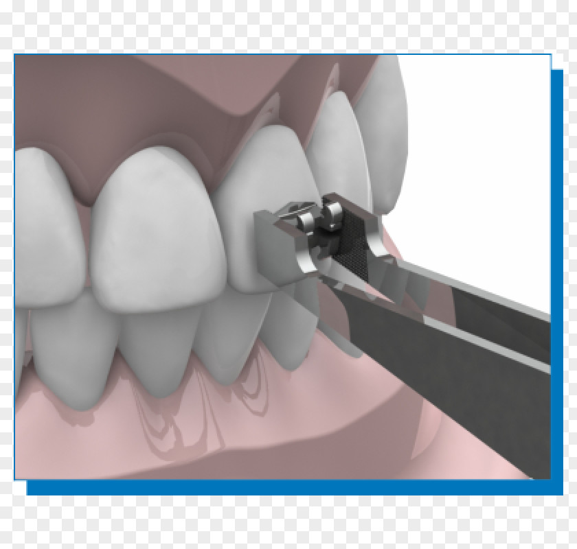 Alicate Dental Braces Orthodontics Tweezers Tooth Dentistry PNG