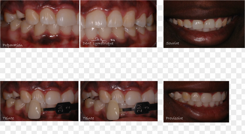 Tooth Premolar Dentistry Incisor Ceramic PNG