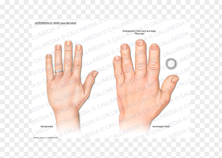 Hand Thumb Acromegaly Endocrinology Growth Hormone PNG