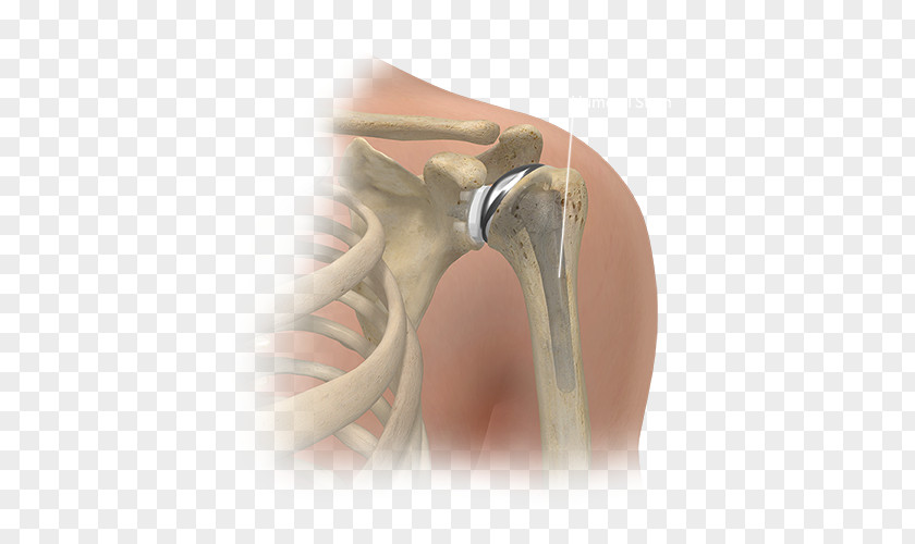 American Joint Replacement Registry Shoulder Surgery Knee PNG