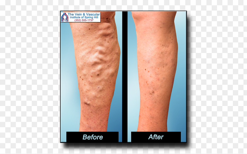 Varicose Veins Vascular Surgery The Vein And Institute Of Tampa Bay Telangiectasia PNG