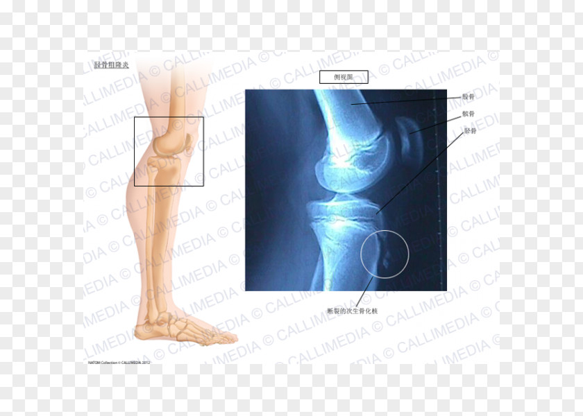Knee Osgood–Schlatter Disease Ossification Tibia PNG