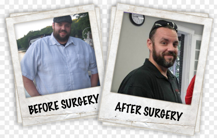 Weight Loss Success Tom Segura Gastric Bypass Surgery Sleeve Gastrectomy Roux-en-Y Anastomosis PNG