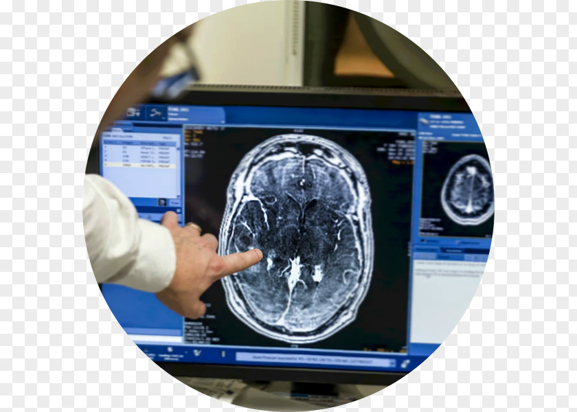 Brain Blood–brain Barrier Scientist Cancer Surgery PNG