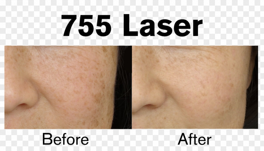 Arm Eyebrow Laser Hair Removal Skin PNG