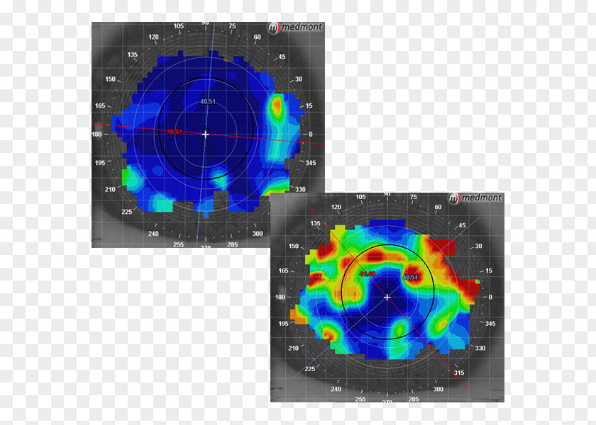 Eye Dry Syndrome Corneal Topography Examination Optometry PNG