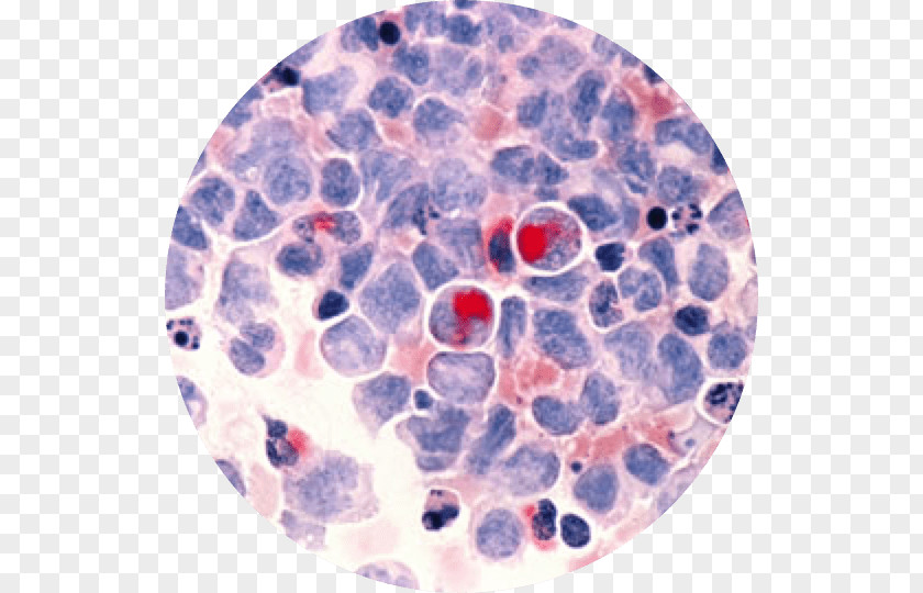 Acute Myeloid Leukemia Cancer Gemtuzumab Ozogamicin Lymphoblastic PNG