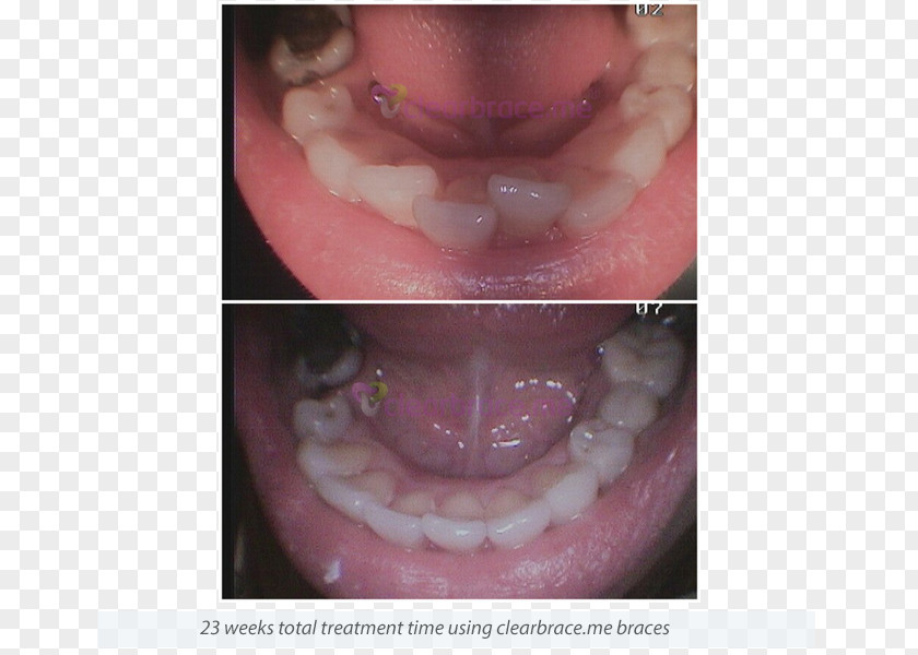 Tooth Dentures Close-up PNG