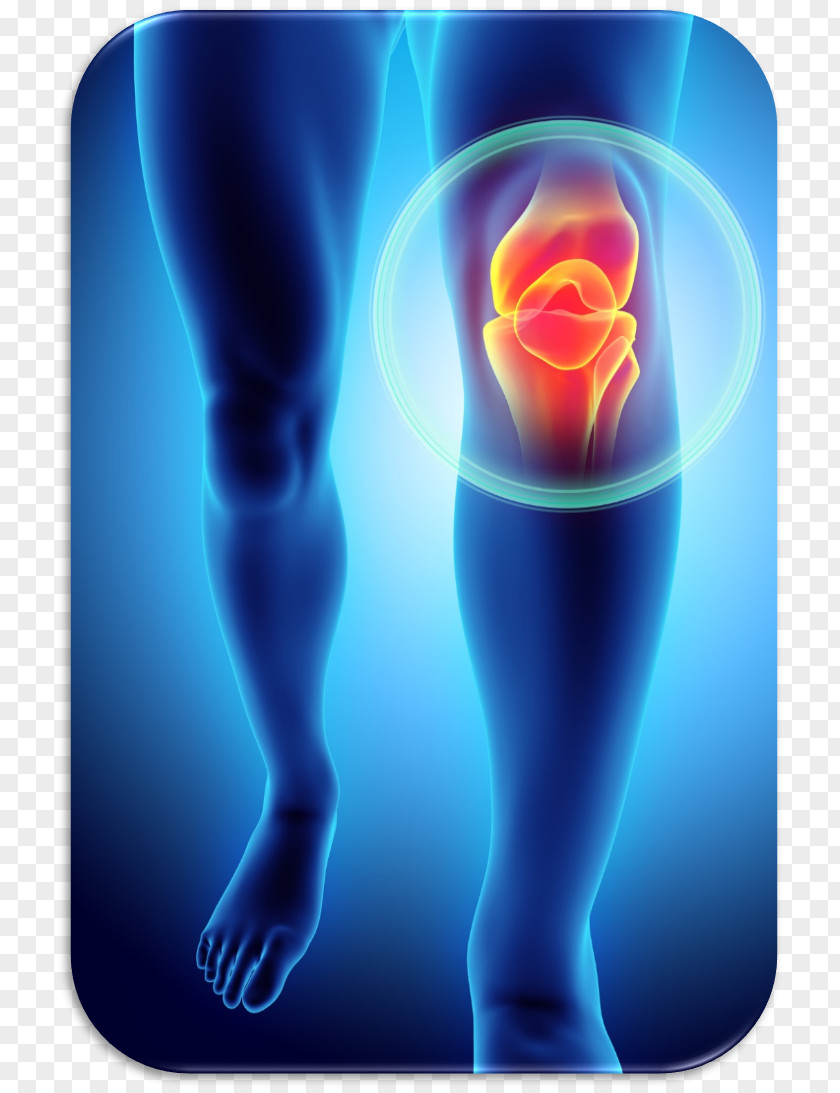 Knee Bone Pain Patellofemoral Syndrome Plica Injury PNG
