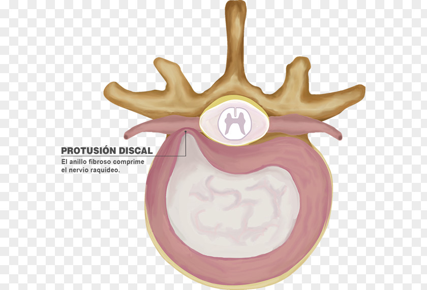 Columna Vertebral Intervertebral Disc Spinal Herniation Lumbar Vertebrae Protrusion PNG