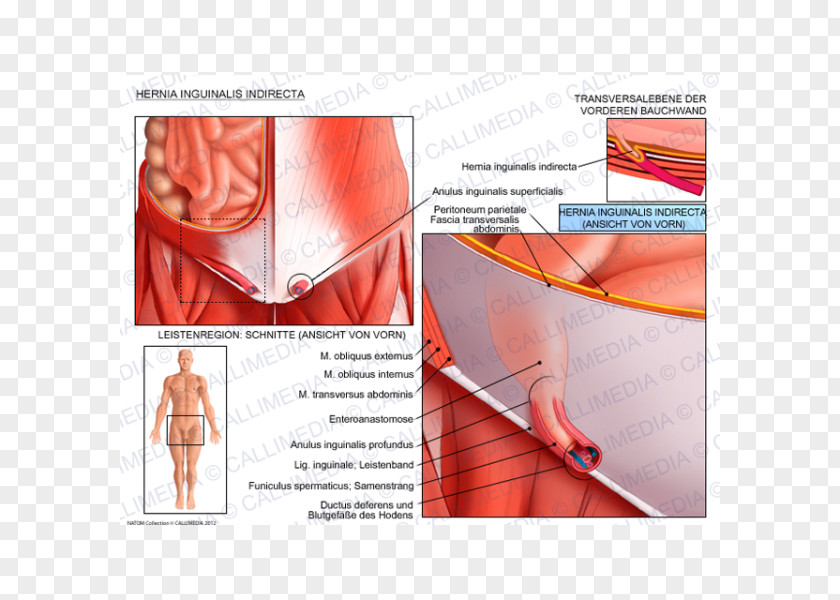 Inguinal Hernia Abdominal External Oblique Muscle Canal Internal PNG