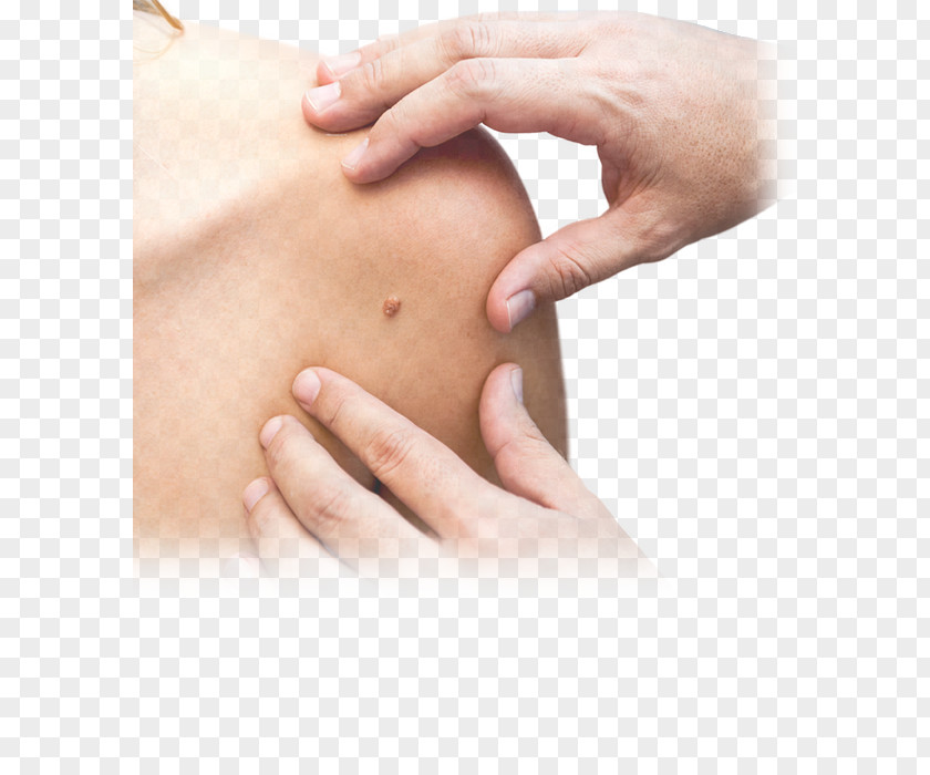 Health Holladay Dermatology Skin Cancer Melanocytic Nevus PNG