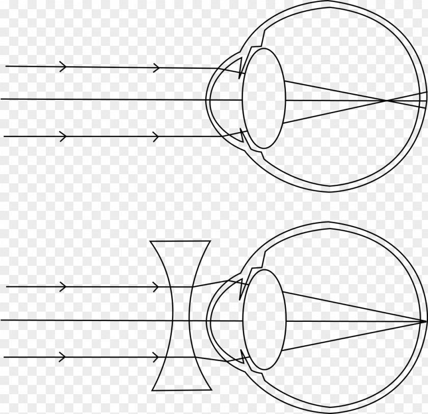 Line Drawing Near-sightedness Hypermetropia Eye Visual Perception Glasses PNG