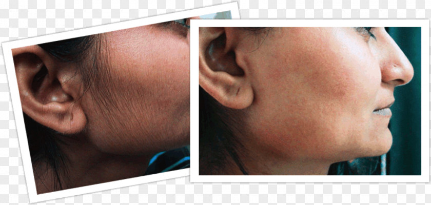 Hair Removal Laser Facial Woman Human Growth PNG
