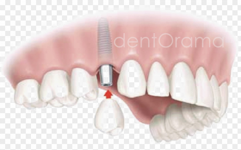 Bridge Dental Implant Dentistry Edentulism Tooth PNG