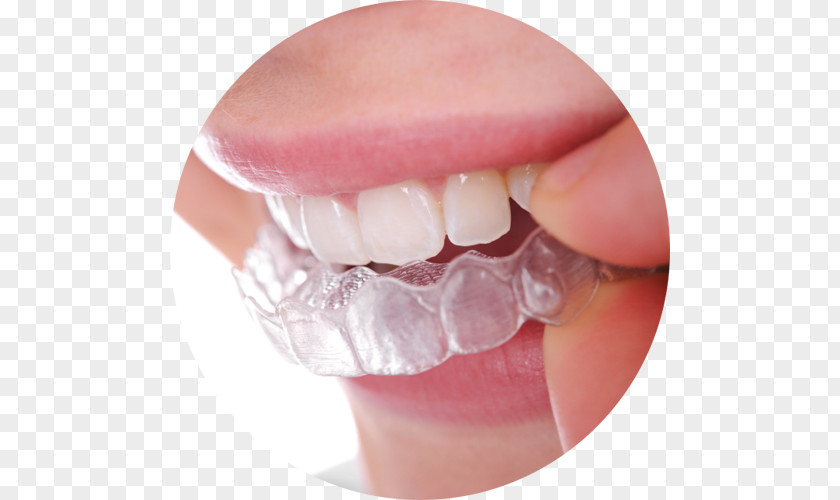 Dental Braces Clear Aligners Dentistry Orthodontics Retainer PNG