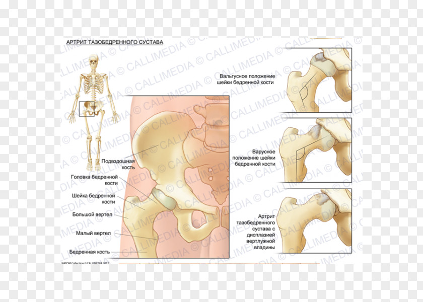 Arthritis Hip Dysplasia Bone Arthritic Pain Femur PNG