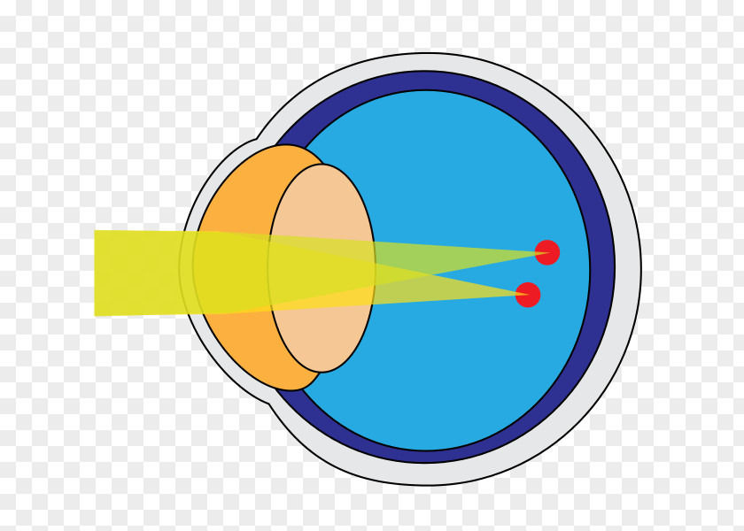 Eye Astigmatism Cornea Disease Near-sightedness PNG
