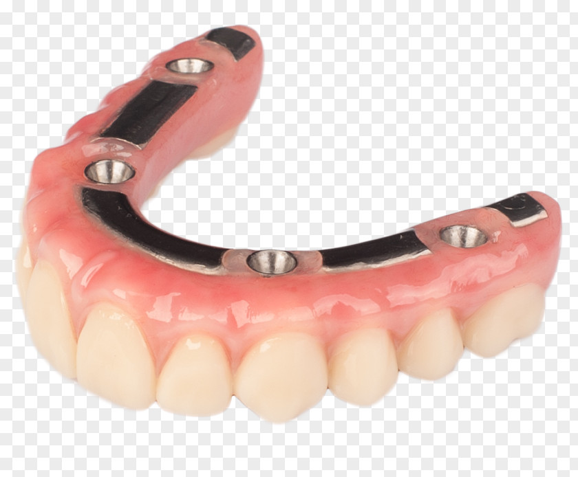 Bridge Tooth Dentures Dental Implant Prosthesis PNG