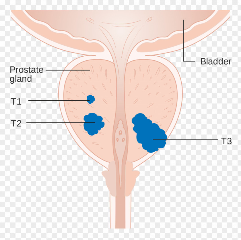 Health Prostate Cancer Staging Carcinoma In Situ PNG