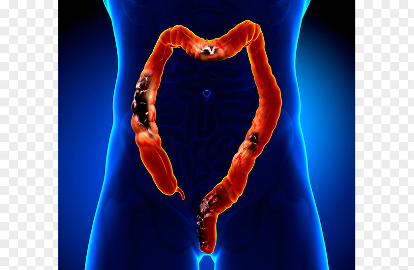 Colorectal Cancer Surgery Large Intestine Polyp PNG