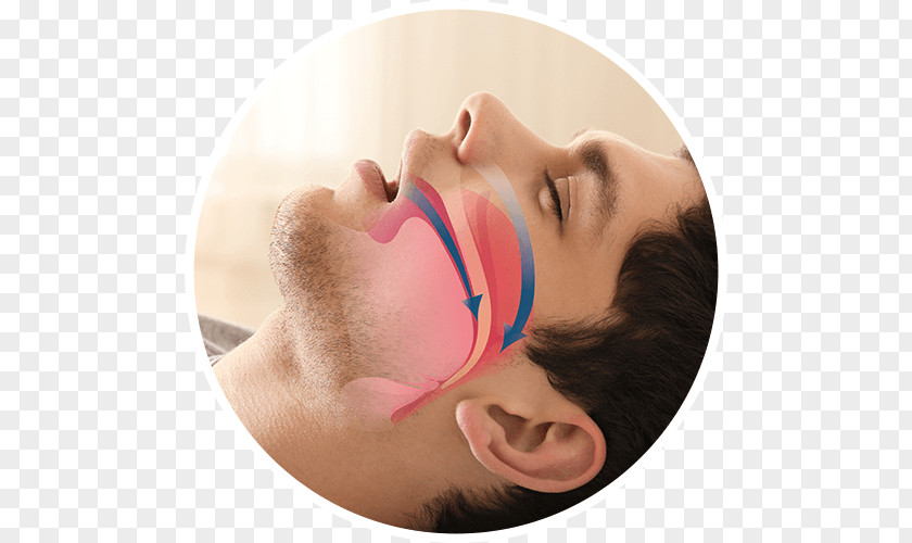 Sleep Disorder Obstructive Apnea Snoring Mandibular Advancement Splint Dentist PNG