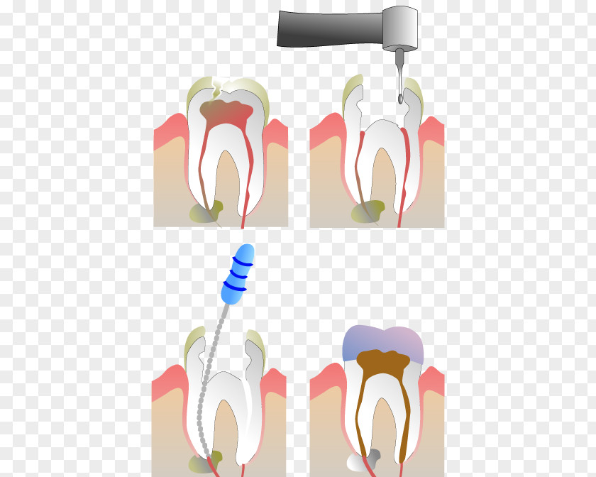 Endodoncia Endodontic Therapy Root Canal Dentistry PNG