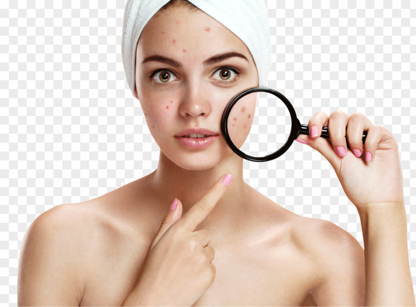 Powder Effect Pimple Acne Benzoyl Peroxide Therapy Skin PNG