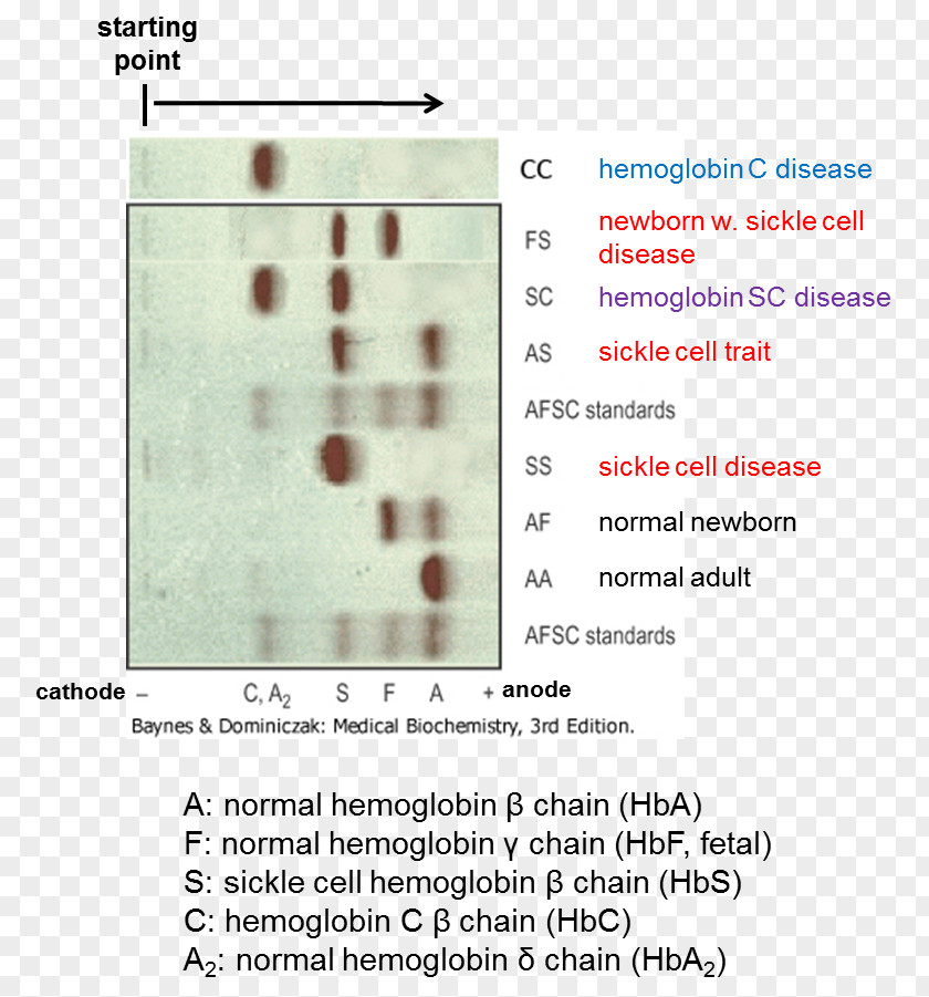 Sickle Cell Disease Hemoglobin C Hemoglobinopathy Electrophoresis PNG