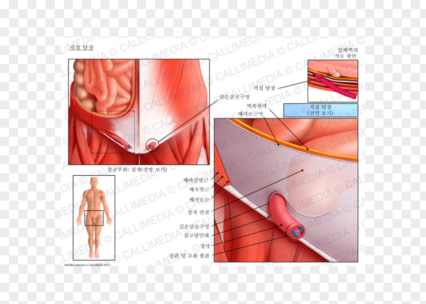 Internal Hernia Inguinal Abdominal External Oblique Muscle Canal Anatomy PNG