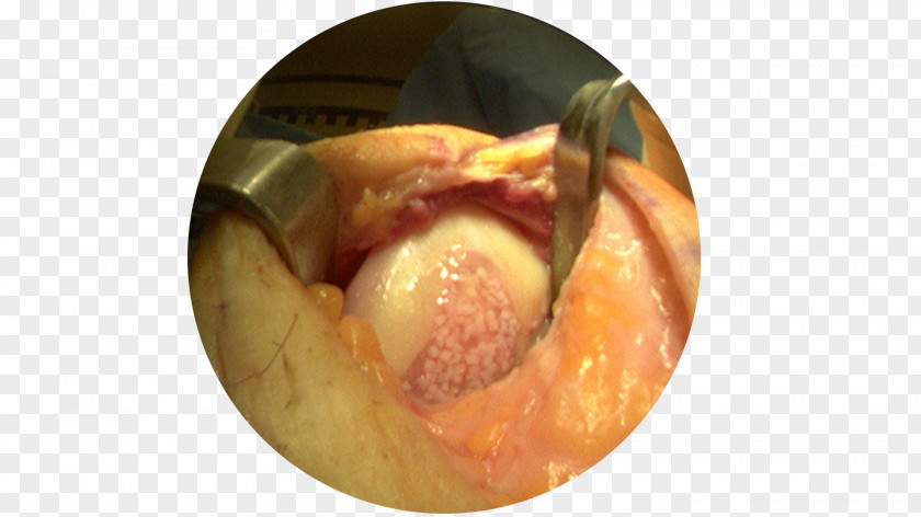 Graft Surgery Arthroscopy Knee Arthrotomy PNG