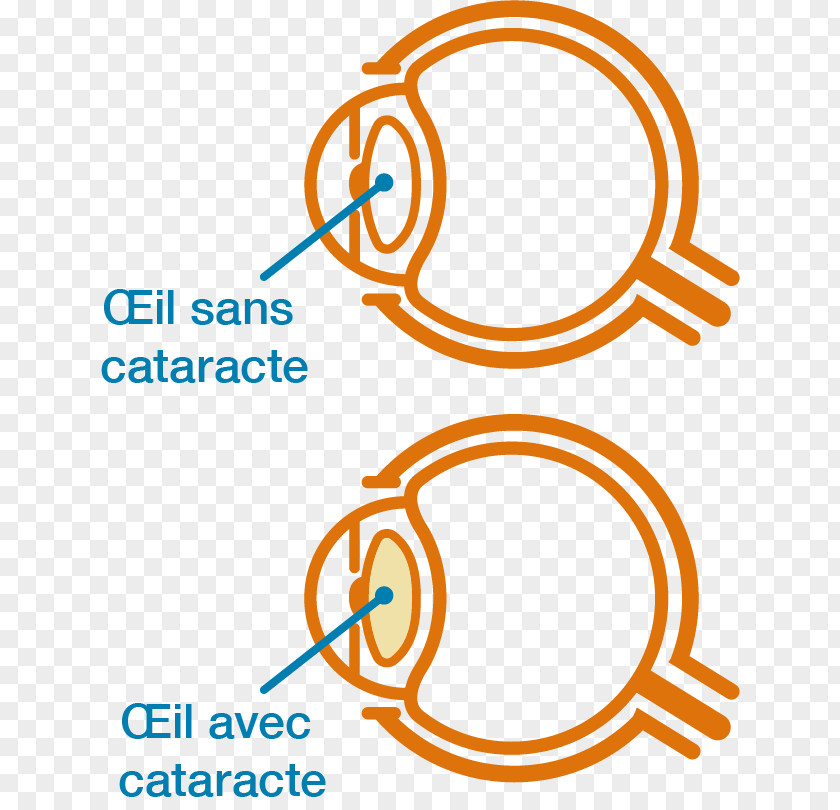 Eye Diagram Cataract Vector Graphics Clip Art Stock Illustration PNG