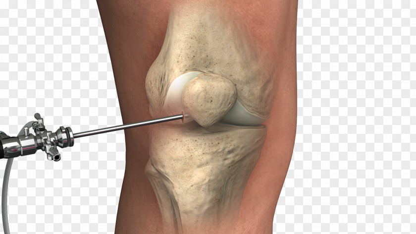 Orthopaedic Surgery Orthopedic Knee Lipogems International SpA Therapy PNG