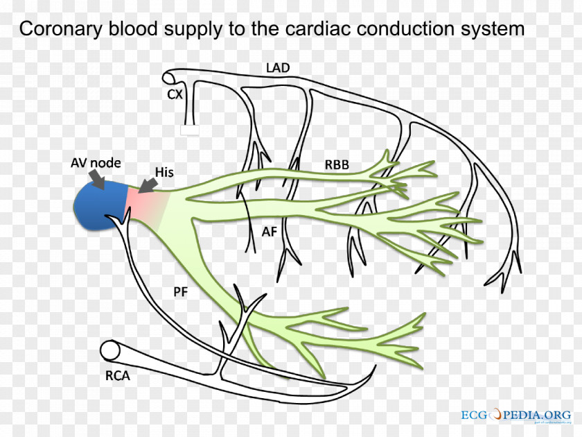 Ischemia Cardiac Muscle Coronary Artery Disease Acute Myocardial Infarction Nutrient PNG